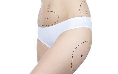 http://www.cmco.fr/uploads/images/apres/CMCO-chirurgie-pour-maigrir-Bodylift.jpg