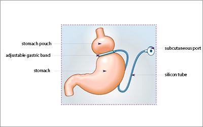 http://www.cmco.fr/uploads/images/operations/CMCO-Chirurgie-de-l-obesite-Anneau-gastrique_en.jpg