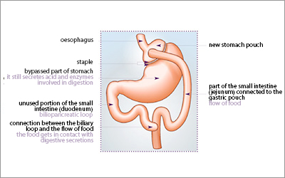 http://www.cmco.fr/uploads/images/operations/CMCO-Chirurgie-de-l-obesite-By-pass_en.jpg