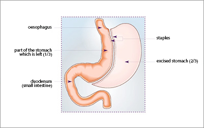 http://www.cmco.fr/uploads/images/operations/CMCO-Chirurgie-de-l-obesite-Sleeve_en.jpg